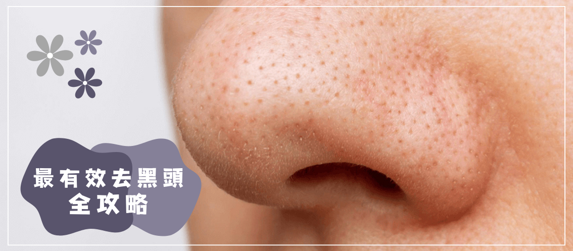 特寫鏡頭：人的鼻子上有明顯的黑頭；左邊的中文寫著「最有效的去黑頭指南。.