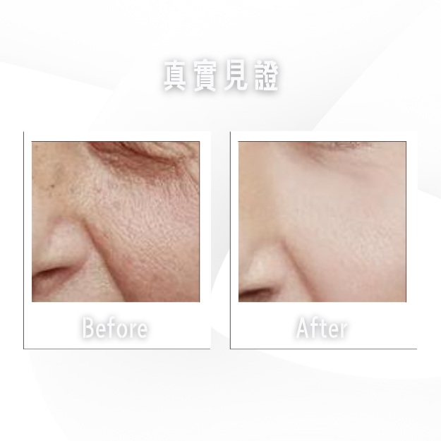 眼睛附近皮膚的並排特寫影像，標示出「之前」的皺紋和「之後」更平滑的皮膚。.