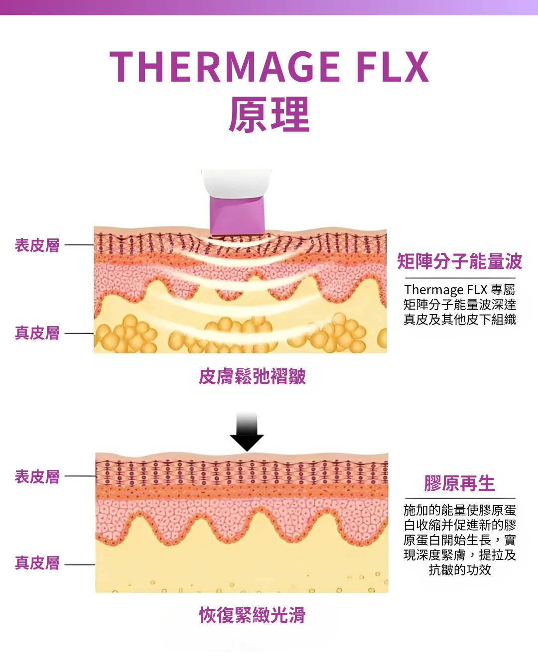 圖表顯示 Thermage FLX 無線射頻能量如何穿透皮膚層，刺激膠原增生、緊緻皮膚，並從表皮層到真皮層進行平滑。.
